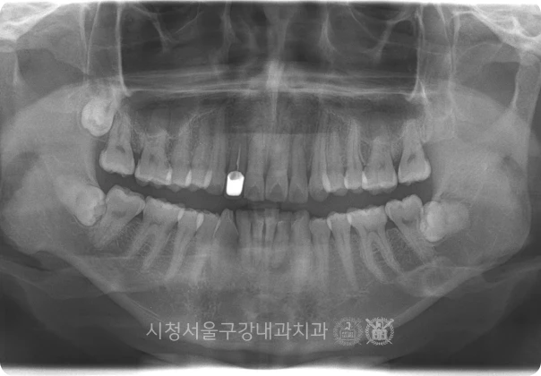 턱과 치아 전체를 촬영한 파노라마 방사선 사진