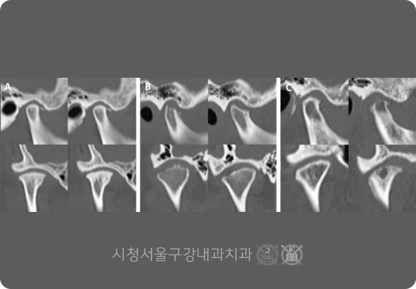 턱관절 과두 뼈의 변화를 비교한 CT 단면 영상