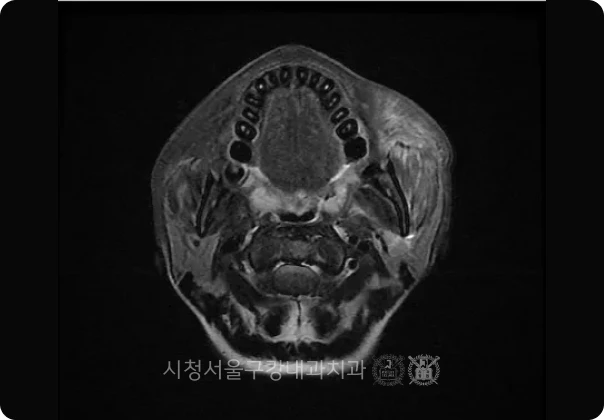 턱관절 디스크 위치를 확인하는 MRI 영상