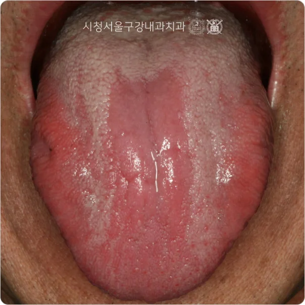 혀 전체에 흰 백태가 낀 구강 칸디다증 임상 사진