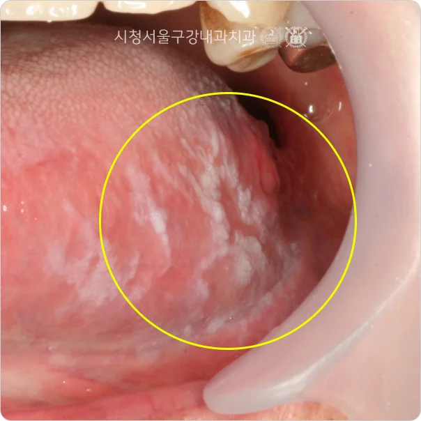 혀 옆면에 흰 병변이 나타난 구강 칸디다증 임상 사진