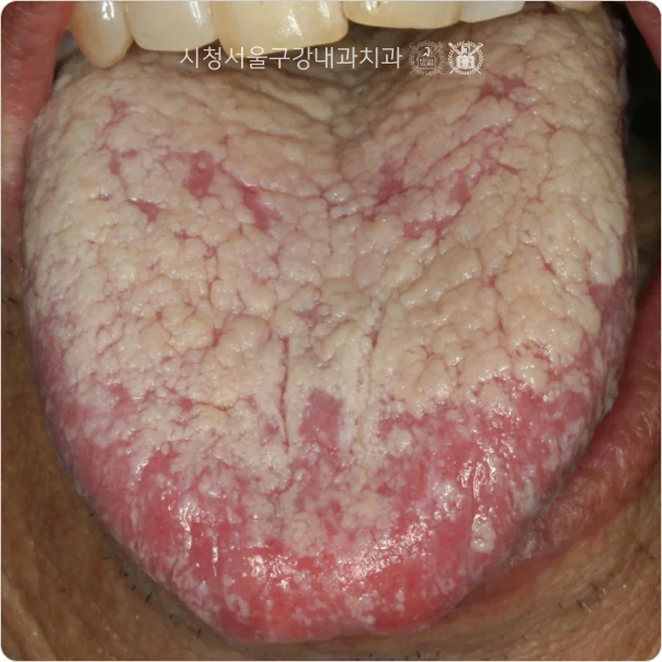 혀 표면이 흰 균막으로 덮인 구강 칸디다증 임상 사진