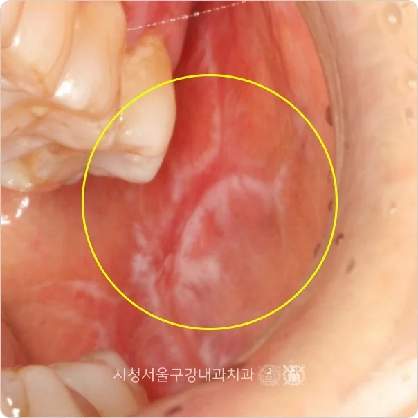 볼 점막에 흰 줄무늬가 나타난 편평태선 임상 사진