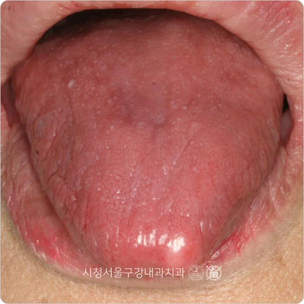 갈라지고 마른 혀를 촬영한 구강건조증 임상 사진
