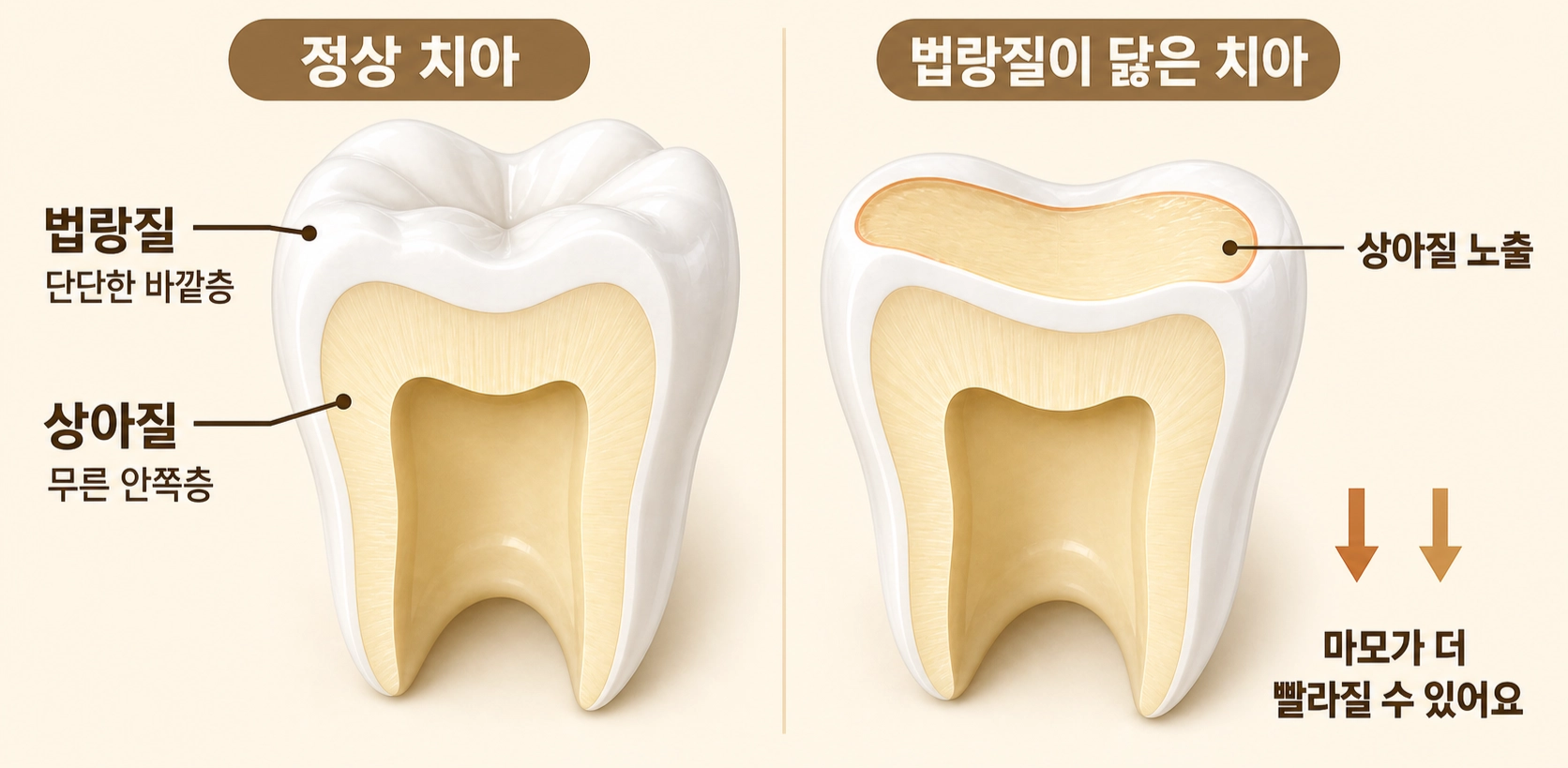 법랑질 마모로 상아질이 드러나는 과정
