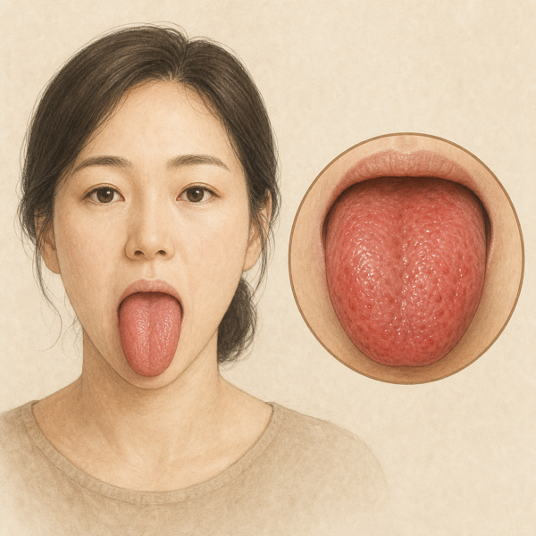 설염 의료 일러스트