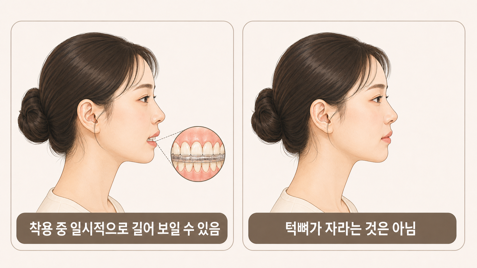 스플린트 착용 중 하관이 길어 보이는 이유.